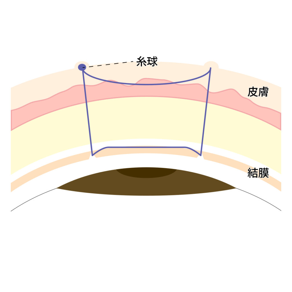 2点どめスクエア法