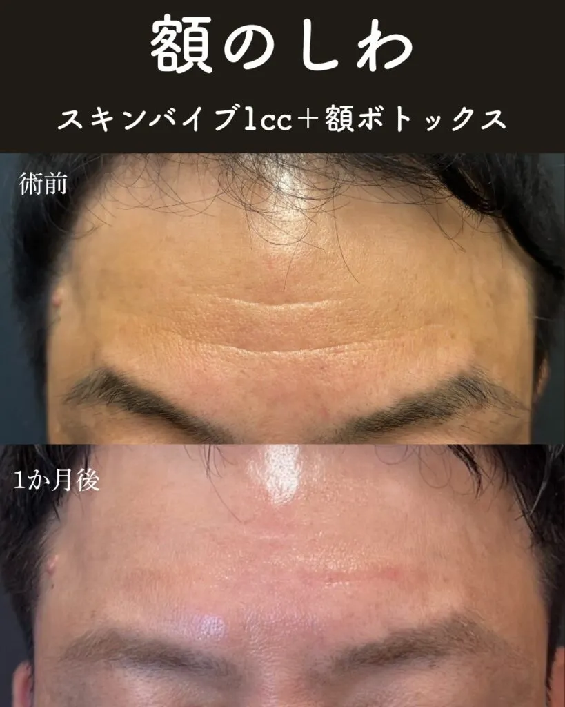 額のしわ1