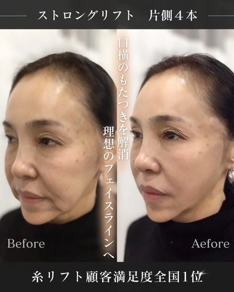 ストロングリフト3