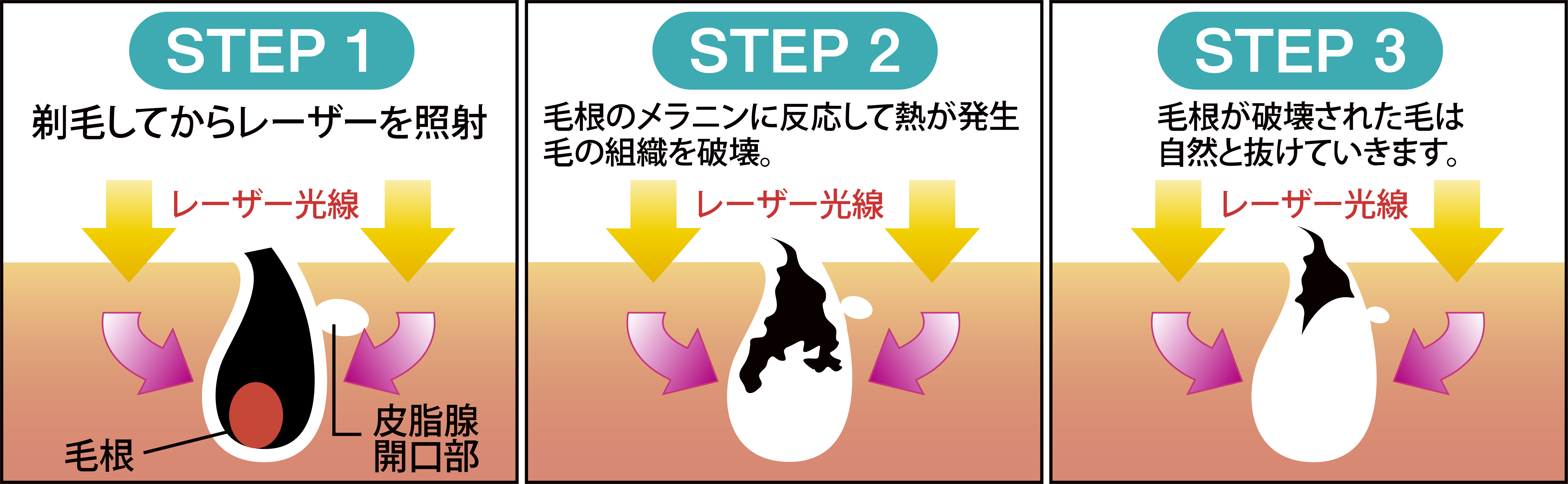 医療脱毛は痛くない?最新の機械で痛みなくつるつるお肌へ（滋賀県 銀座