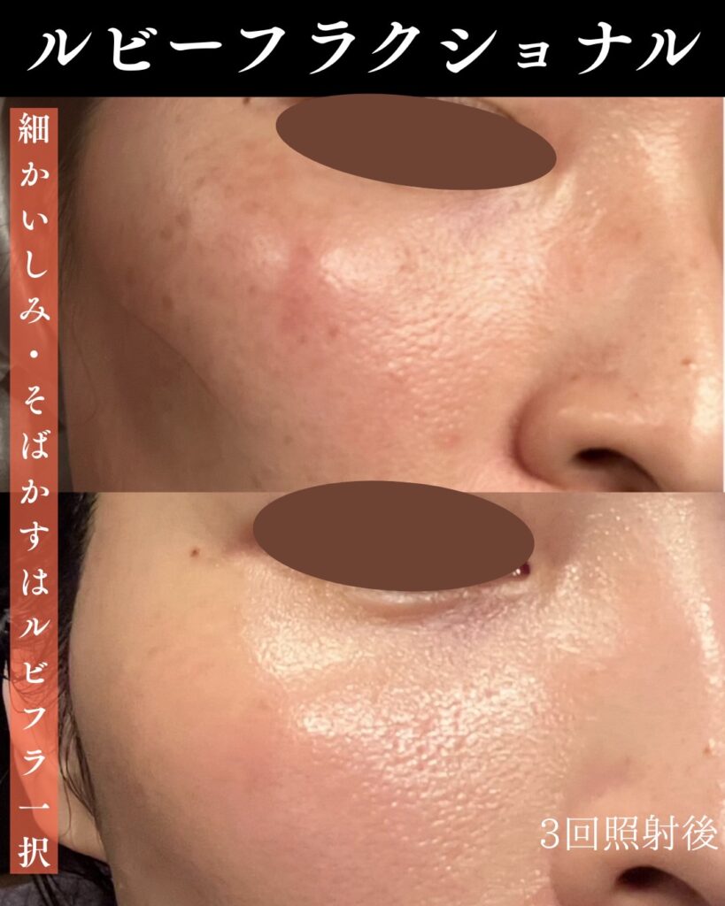 ディスカバリーピコの症例写真-1