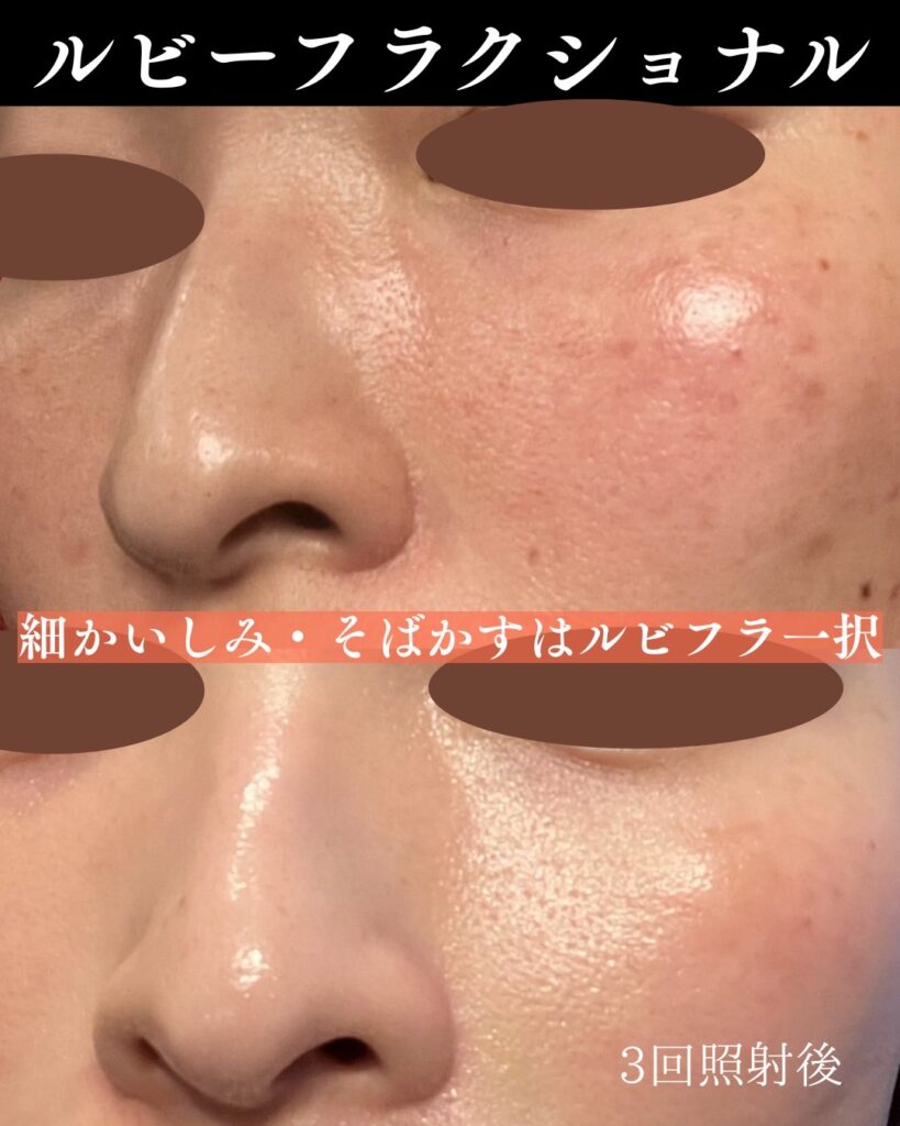 ディスカバリーピコの症例写真-2