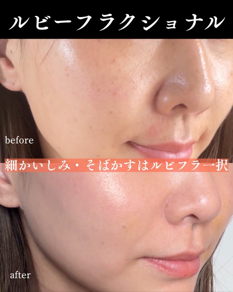 ディスカバリーピコの症例写真-3