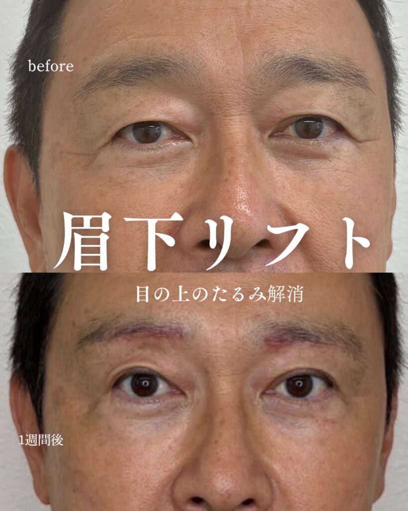 目の周りのたるみ症例写真0813-1