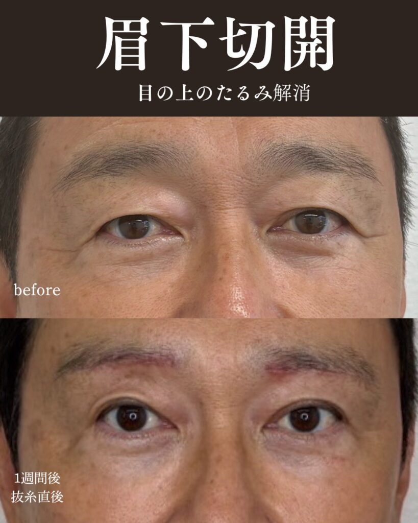目の周りのたるみ症例写真0813-2