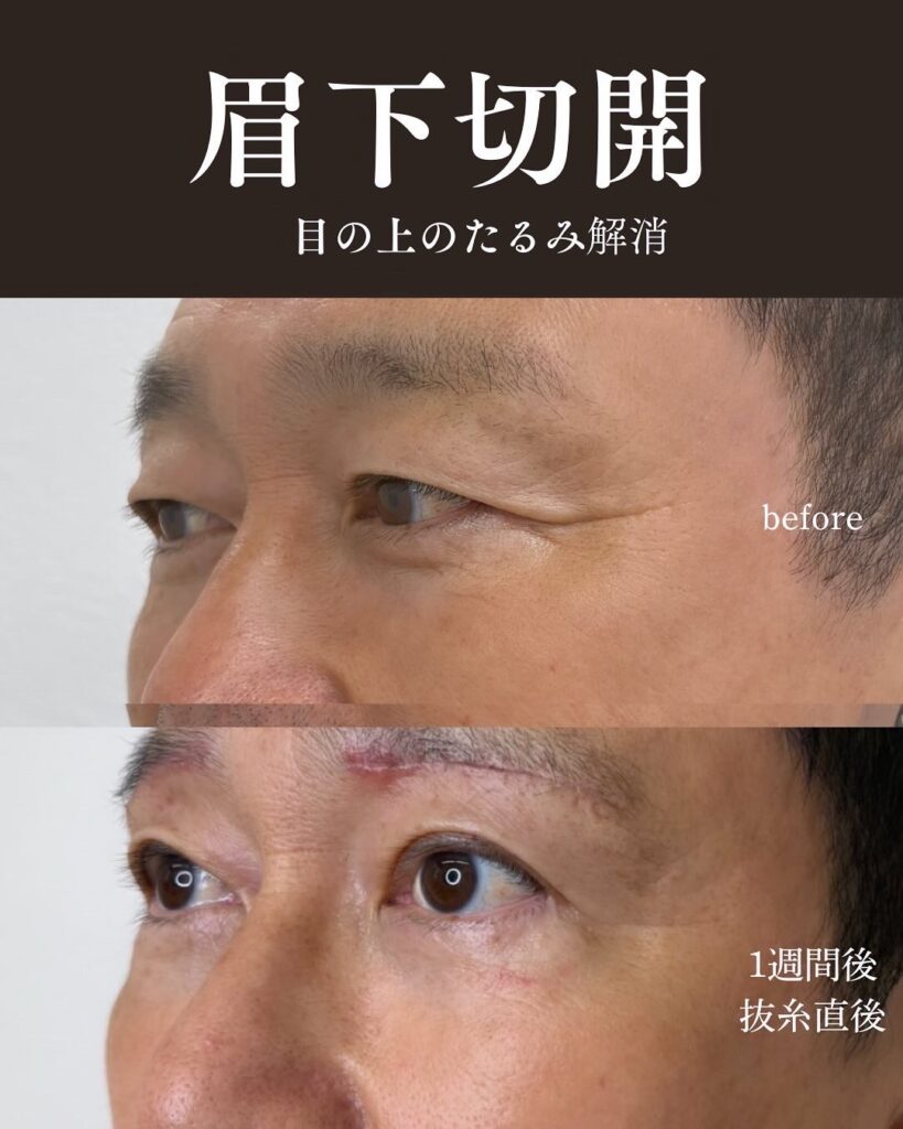目の周りのたるみ症例写真0813-3