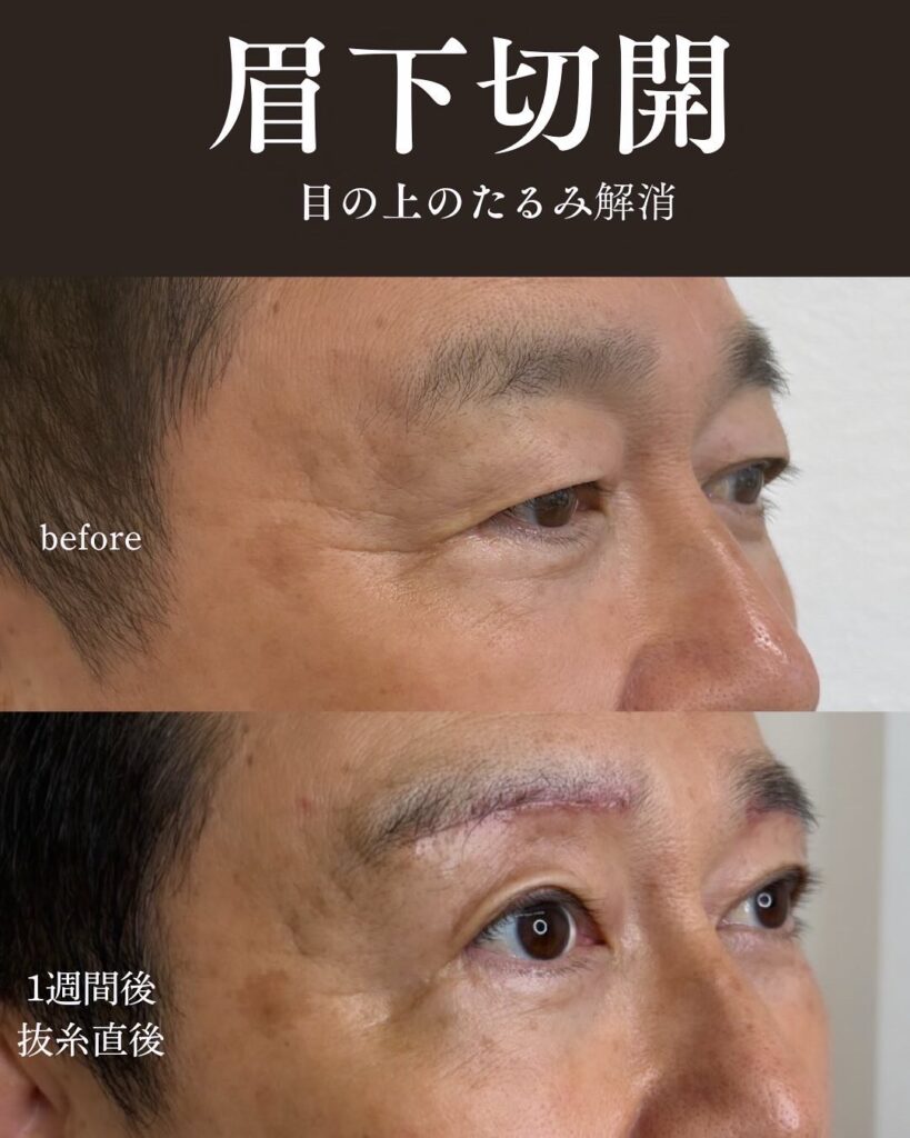 目の周りのたるみ症例写真0813-4