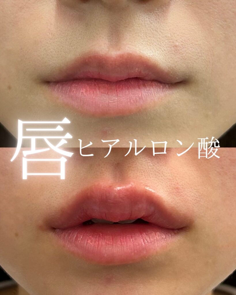 ヒアルロン酸の症例写真0813-2