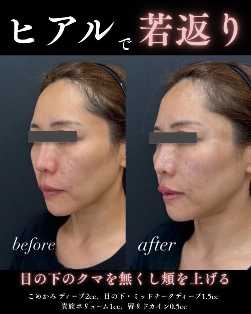 ヒアルロン酸の症例写真0813-3