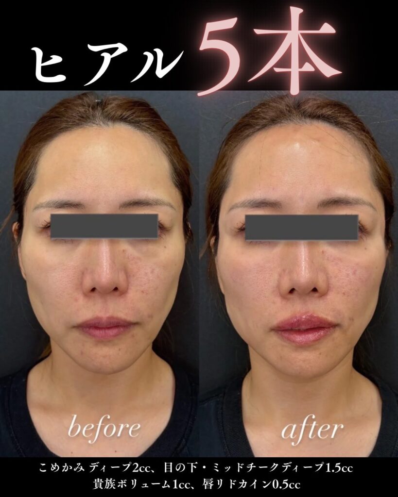 ヒアルロン酸の症例写真0813-4