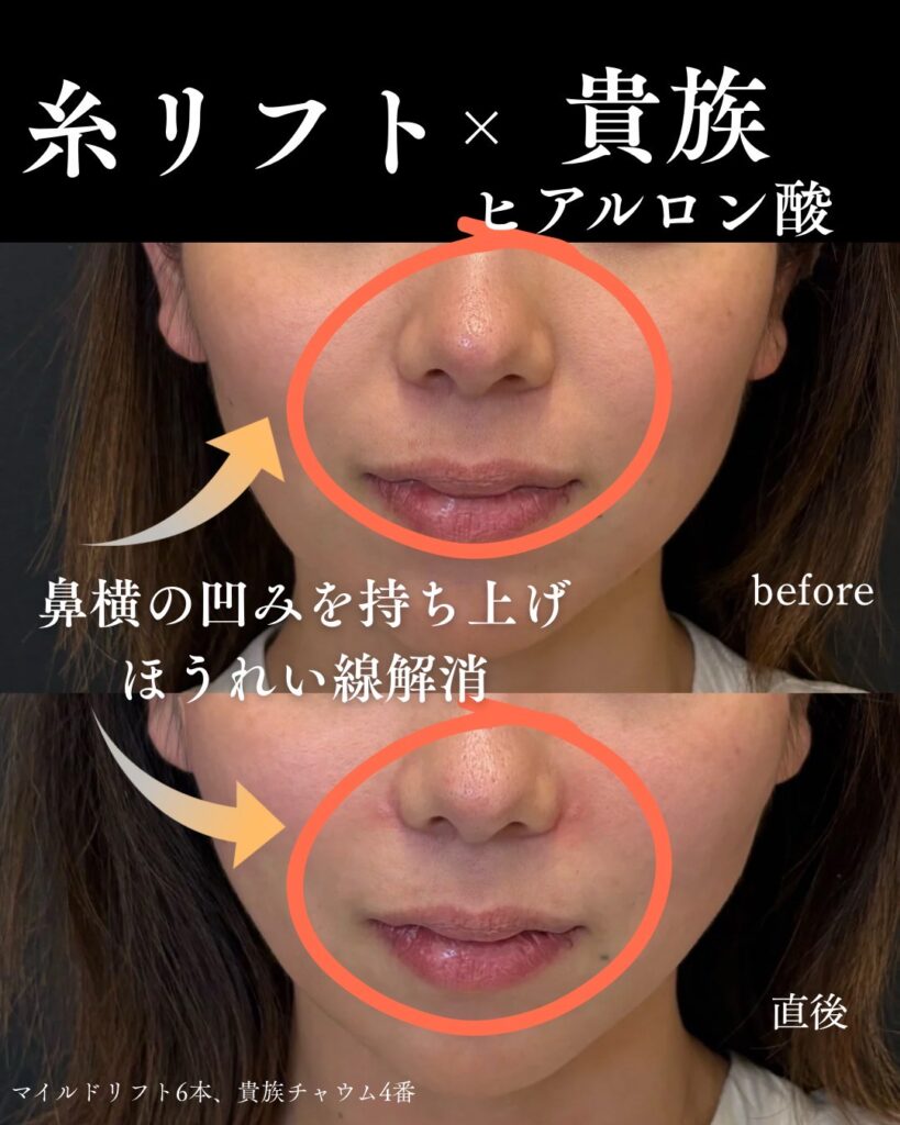 ヒアルロン酸の症例写真0813-7