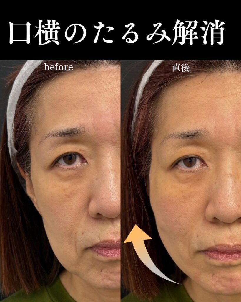 糸リフトの症例写真0813-4