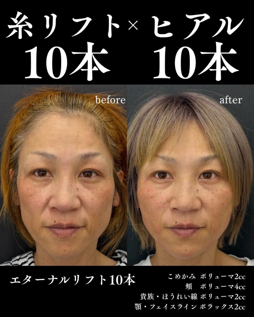糸リフトの症例写真0813-6