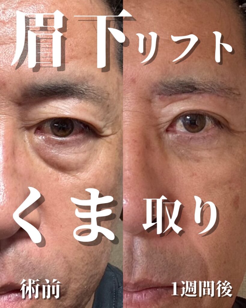 眉下リフト0916