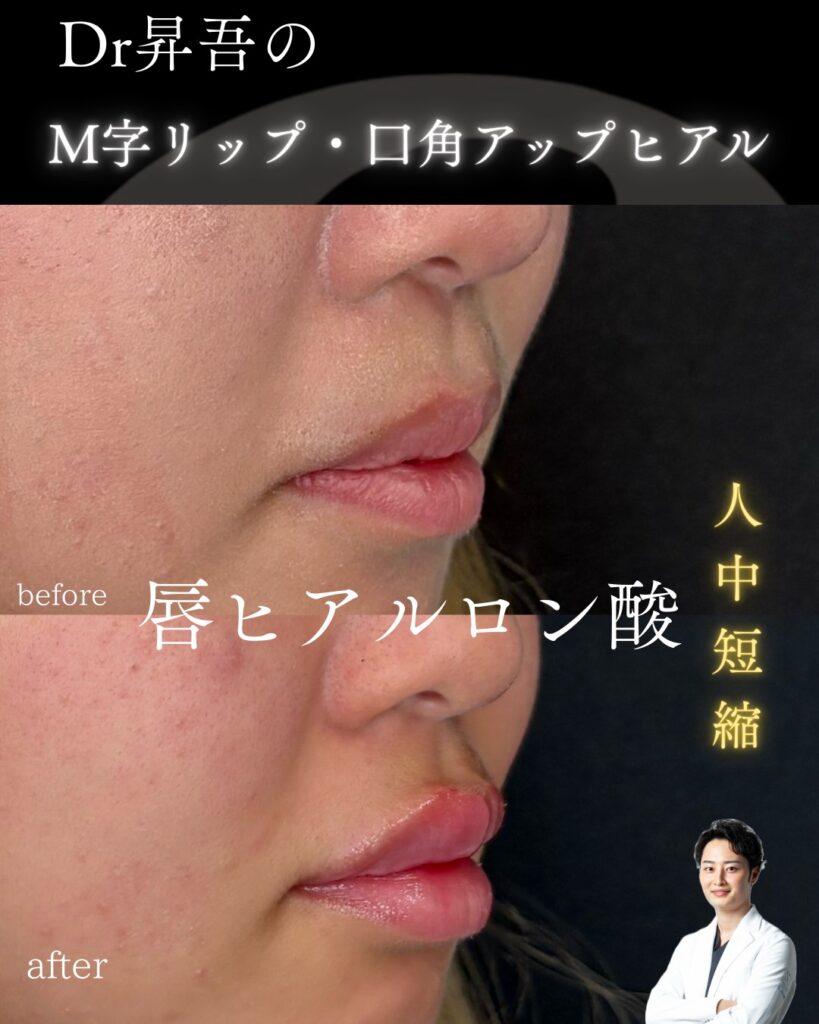 ヒアルロン酸1006-1