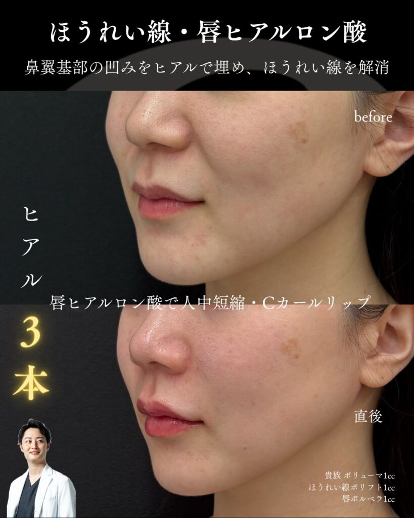 ヒアルロン酸1005-11