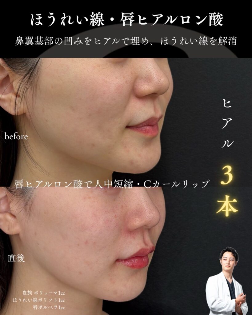 ヒアルロン酸1005-12