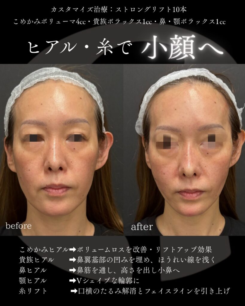糸リフト1005-1