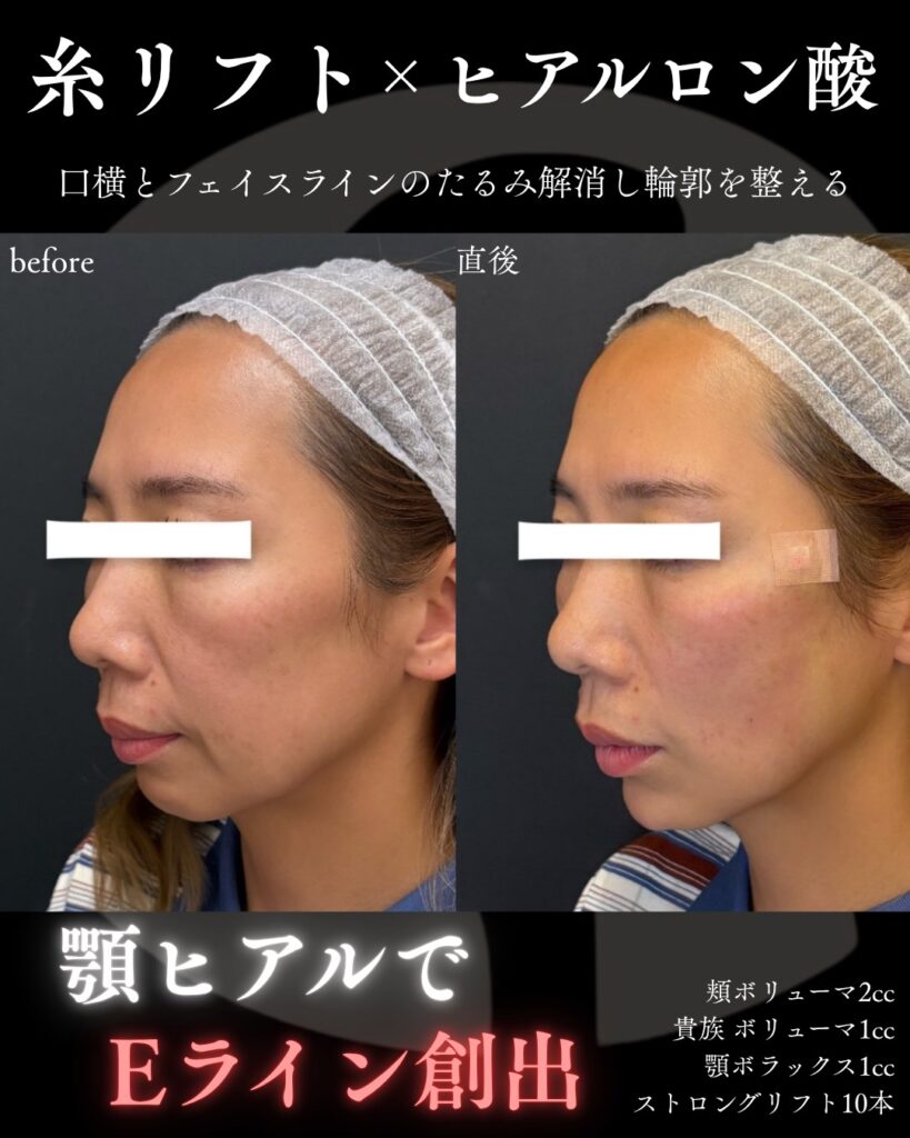 糸リフト1005-3