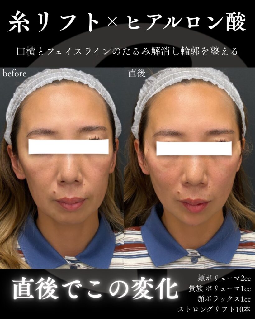 糸リフト1005-4