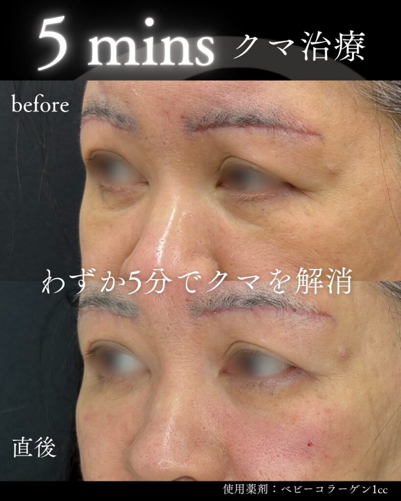 5minsクマ治療