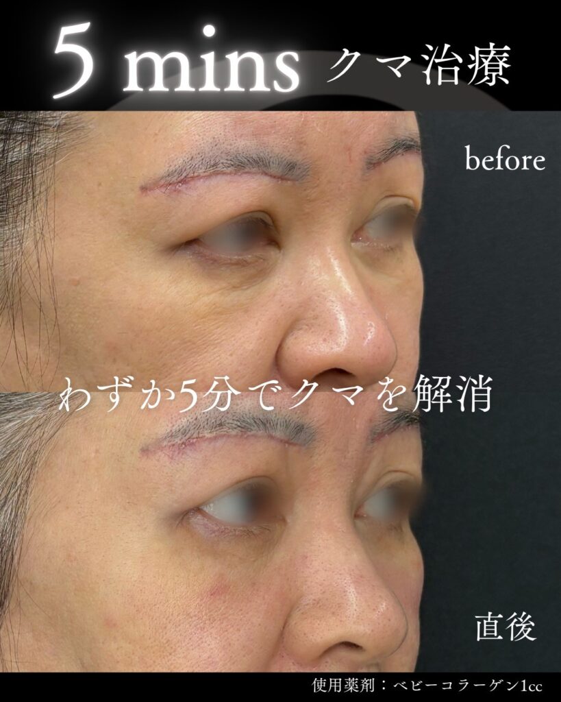 5minsクマ治療