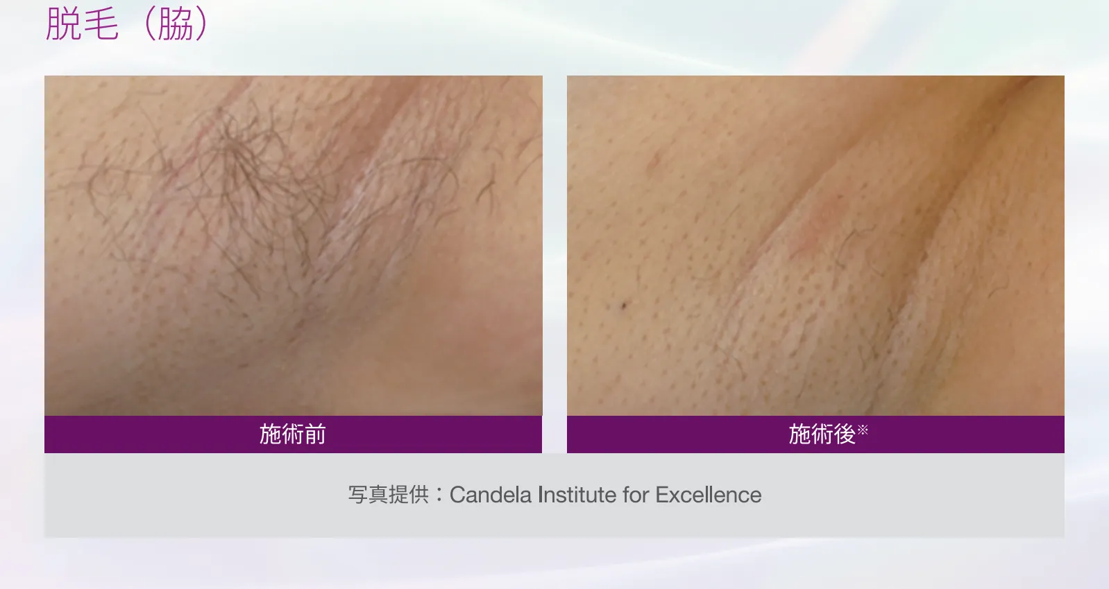 脱毛（脇）