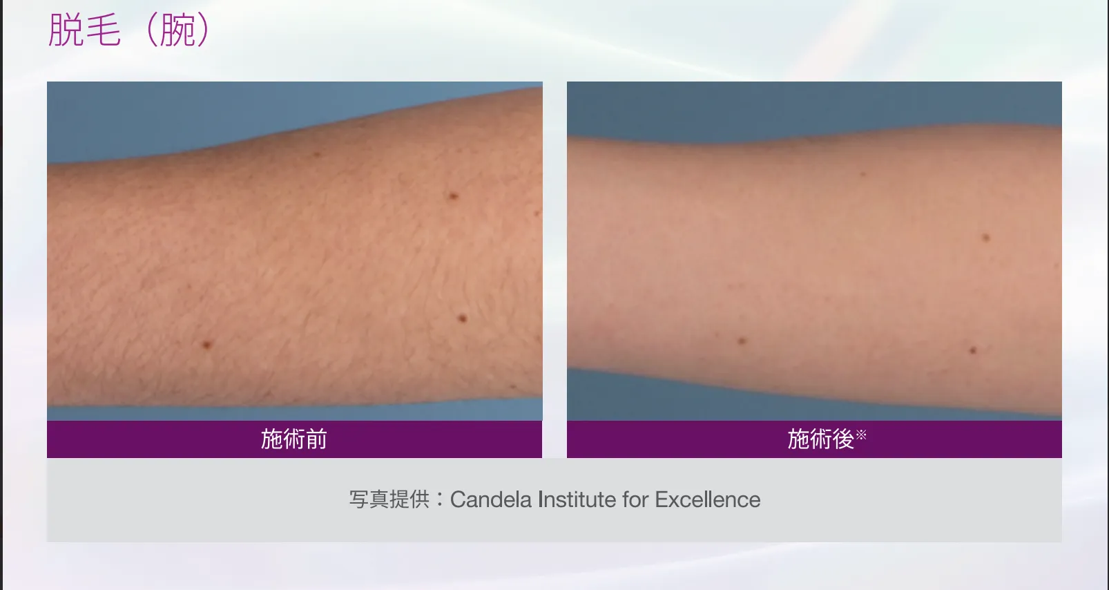 脱毛（腕）