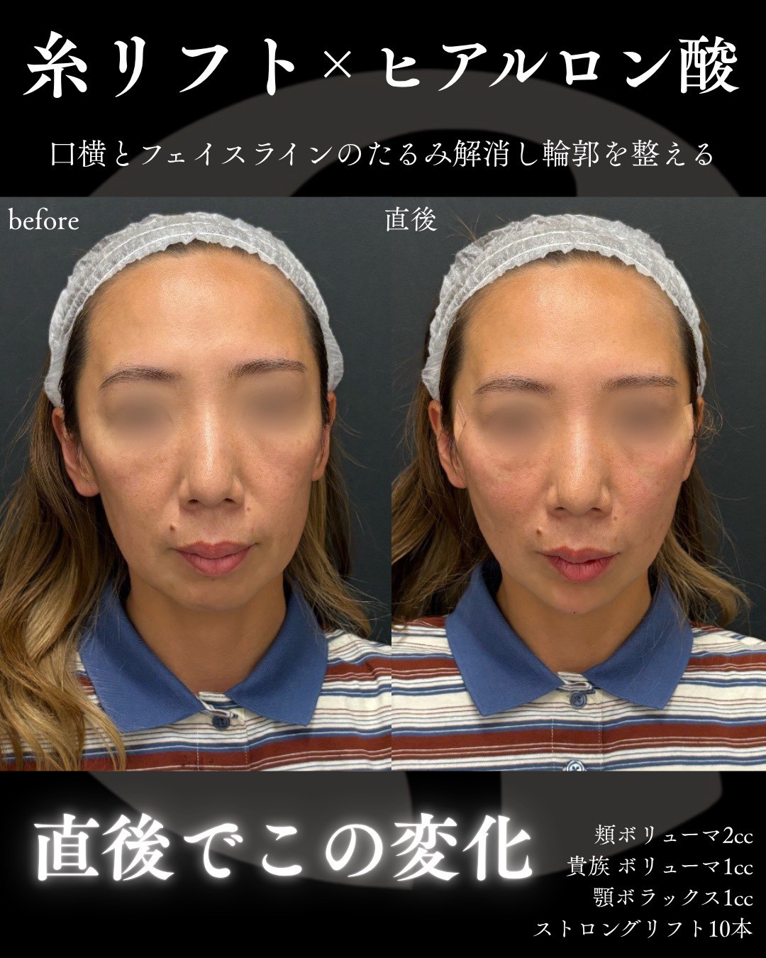 糸リフト症例写真1