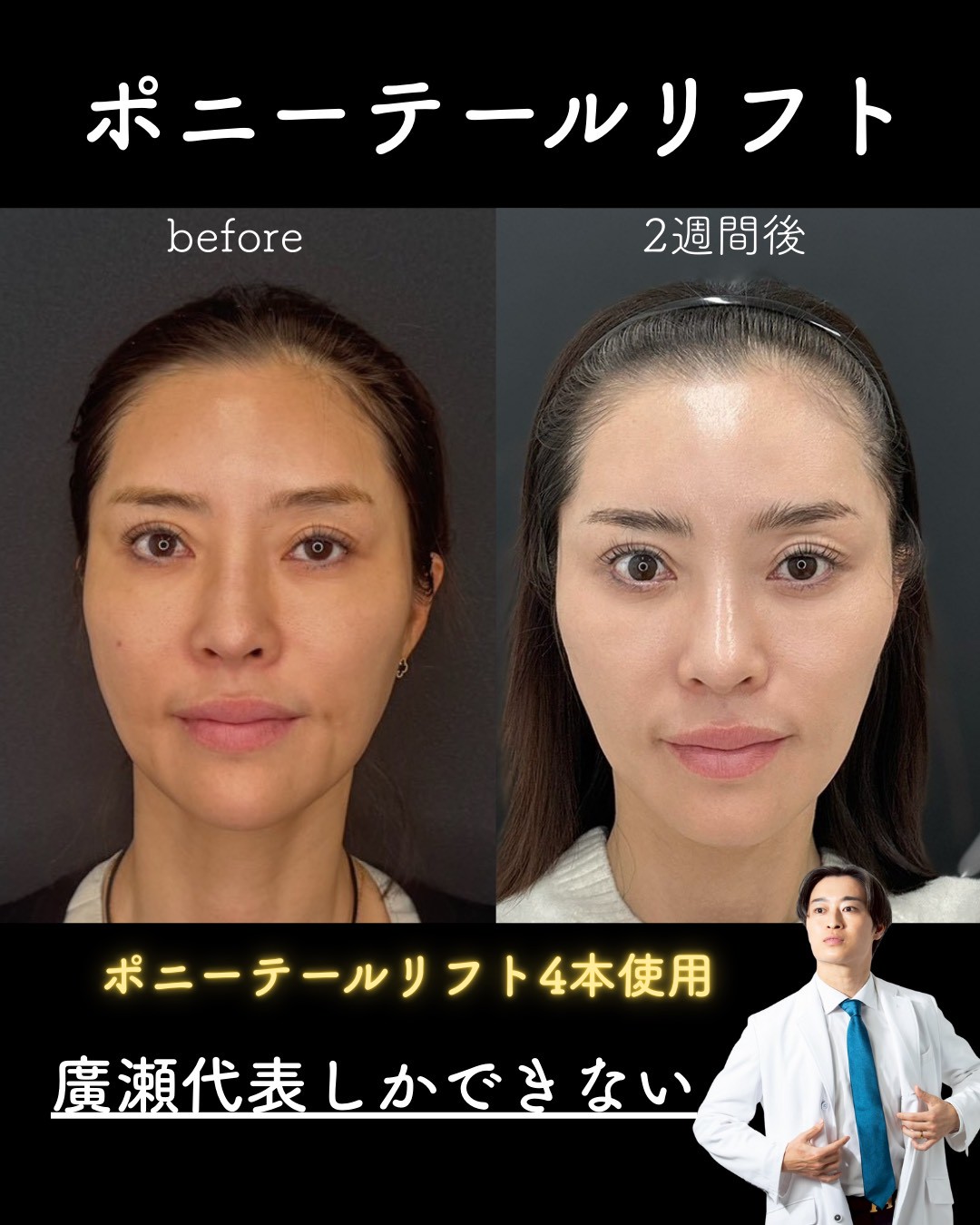 糸リフト症例写真2