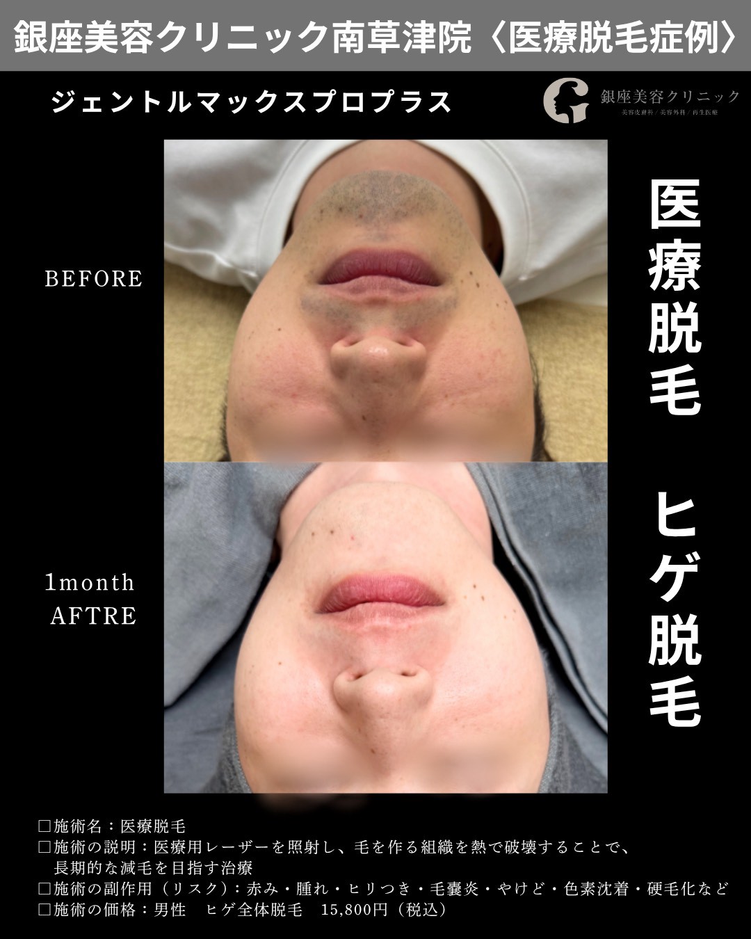 銀座美容クリニック南草津院のヒゲ脱毛症例、正面・顎下。施術前と1回照射から1か月後の経過