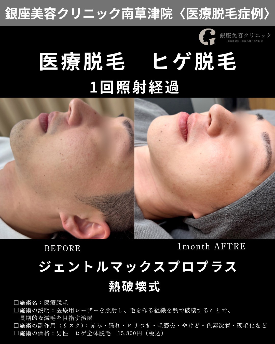 銀座美容クリニック南草津院のヒゲ脱毛症例、横顔①。施術前と1回照射から1か月後の経過