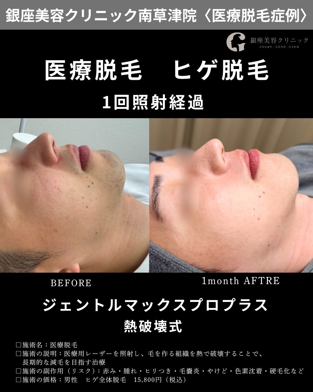 銀座美容クリニック南草津院のヒゲ脱毛症例、横顔②。施術前と1回照射から1か月後の経過