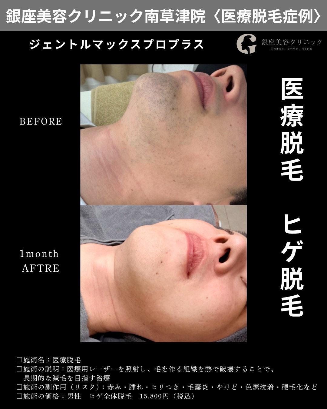 銀座美容クリニック南草津院のヒゲ脱毛症例、顎下のアップ。施術前と1回照射から1か月後の経過