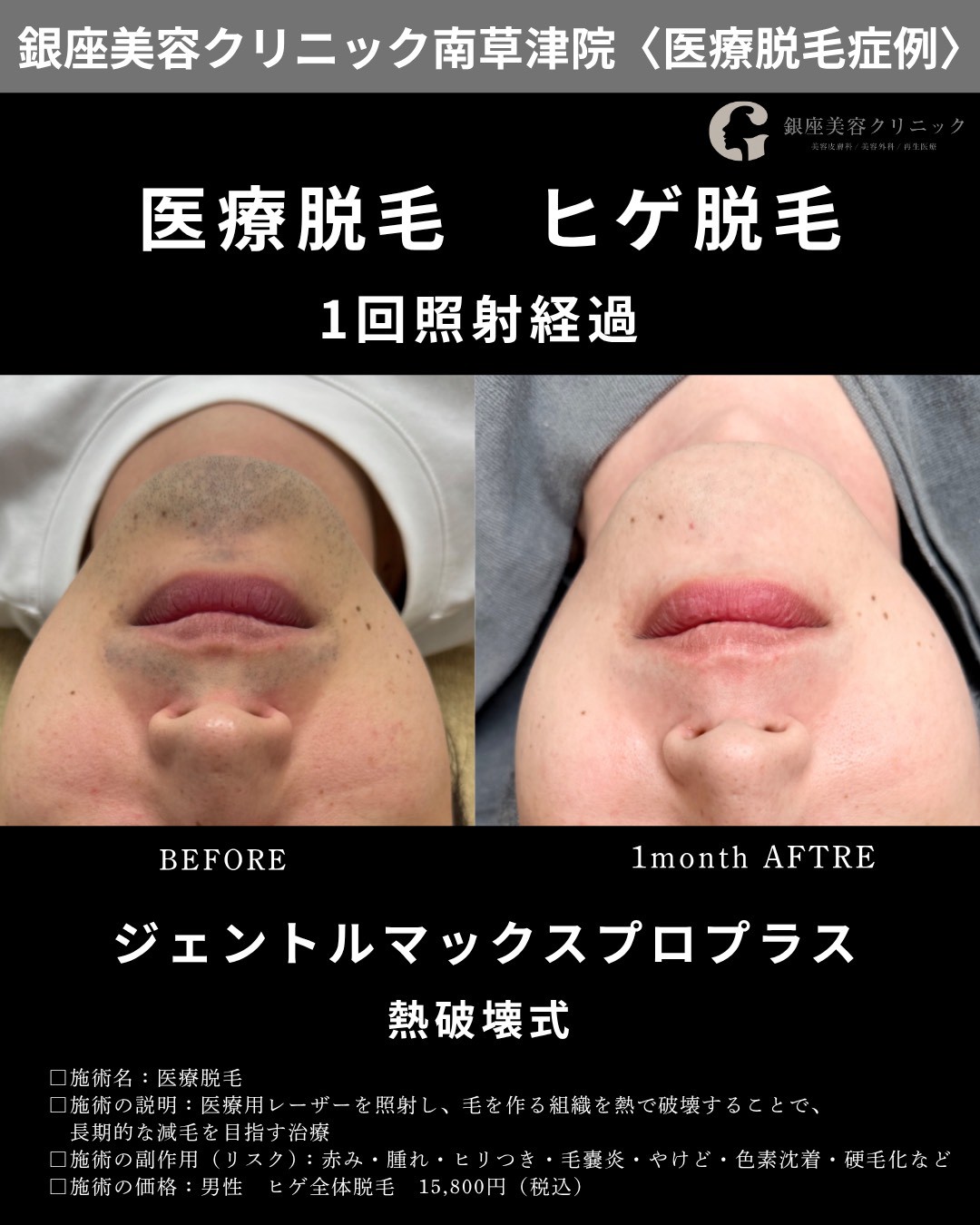 銀座美容クリニック南草津院のヒゲ脱毛症例、正面・口周り。施術前と1回照射から1か月後の経過
